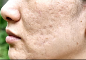 cara menghilangkan bopeng